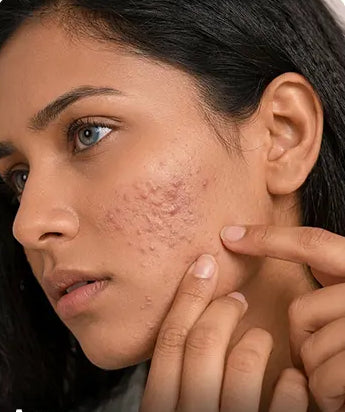 Acne skin concern
