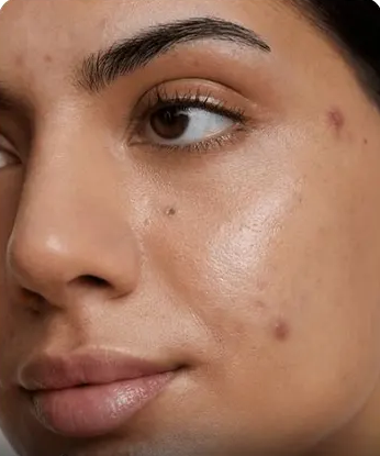 Dark Spots skin concern