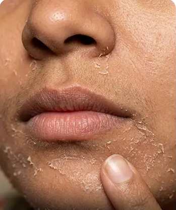 Dry Skin skin concern